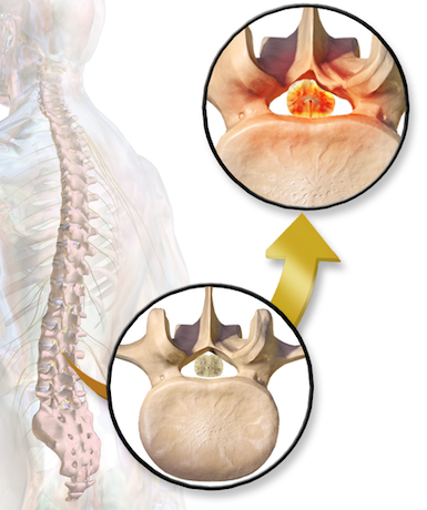 spinal stenosis graphic