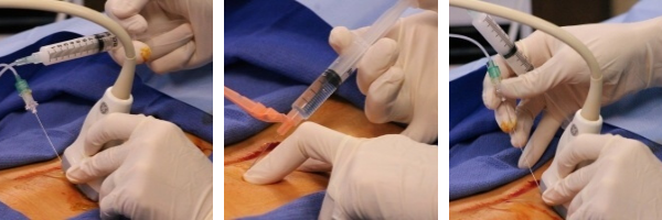 trigger point injection procedure