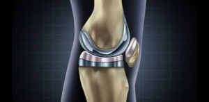 knee replacement pain
