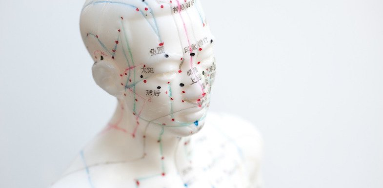 acupuncture for headaches
