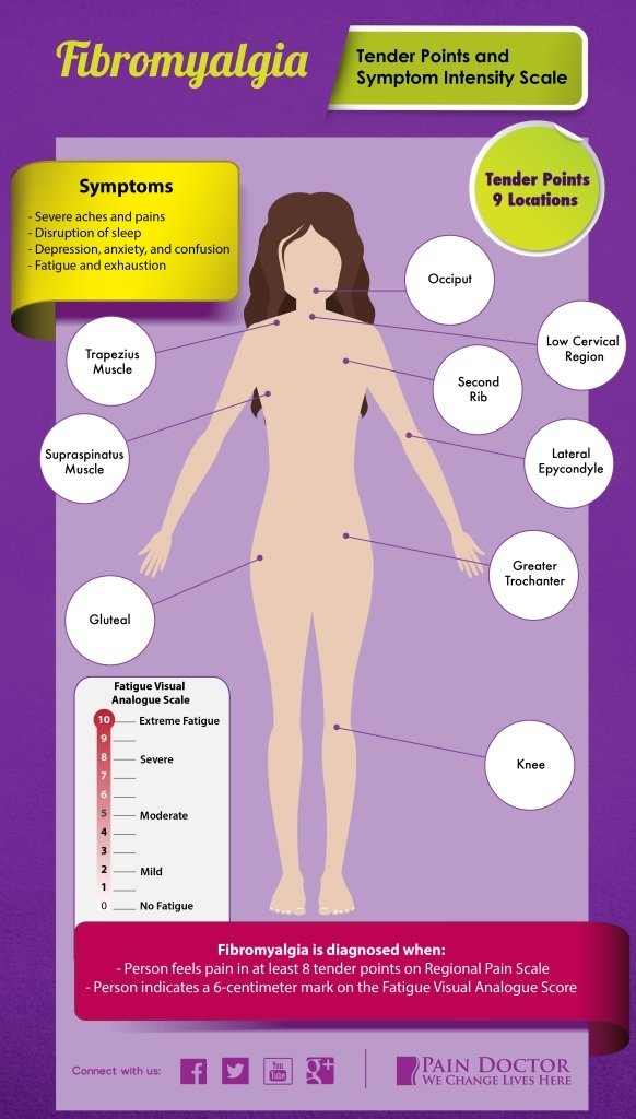 fibromyalgia tender points infographic