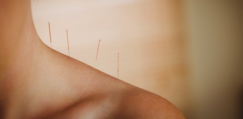 head pain acupuncture